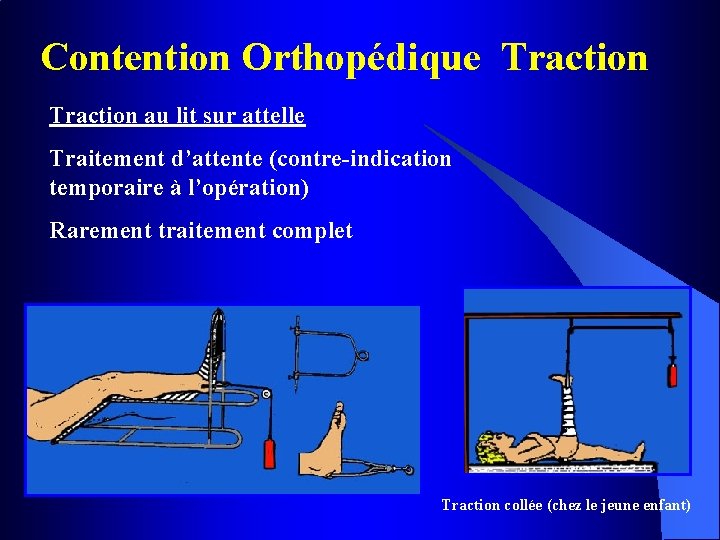 Contention Orthopédique Traction au lit sur attelle Traitement d’attente (contre-indication temporaire à l’opération) Rarement