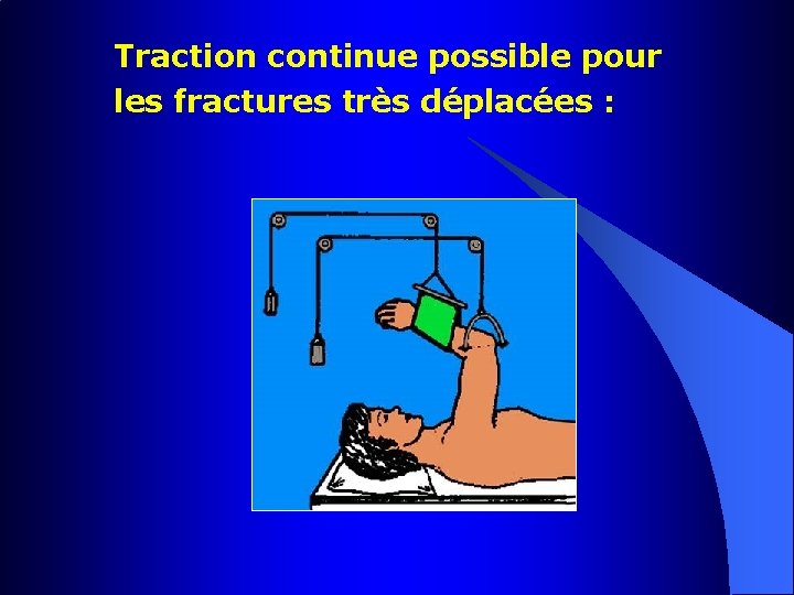 Traction continue possible pour les fractures très déplacées : 