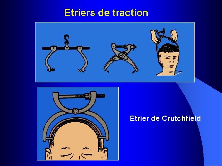 Etriers de traction Etrier de Crutchfield 