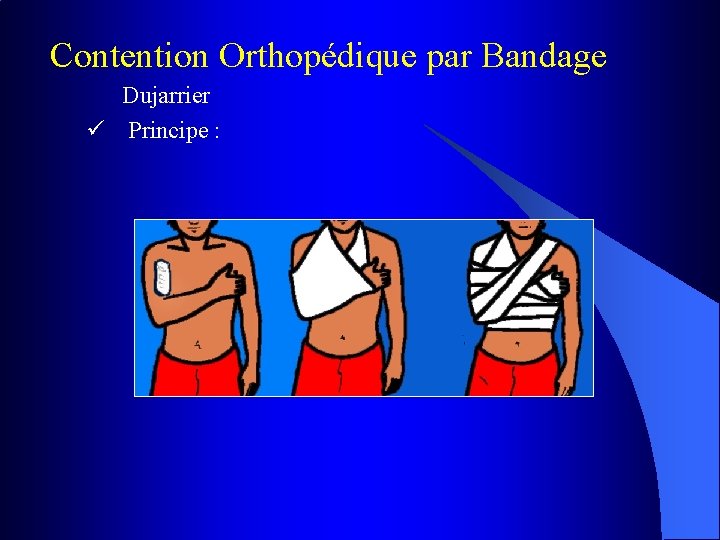 Contention Orthopédique par Bandage Dujarrier ü Principe : 