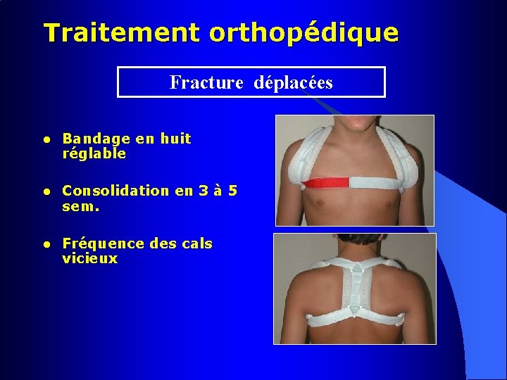 Traitement orthopédique Fracture déplacées l Bandage en huit réglable l Consolidation en 3 à