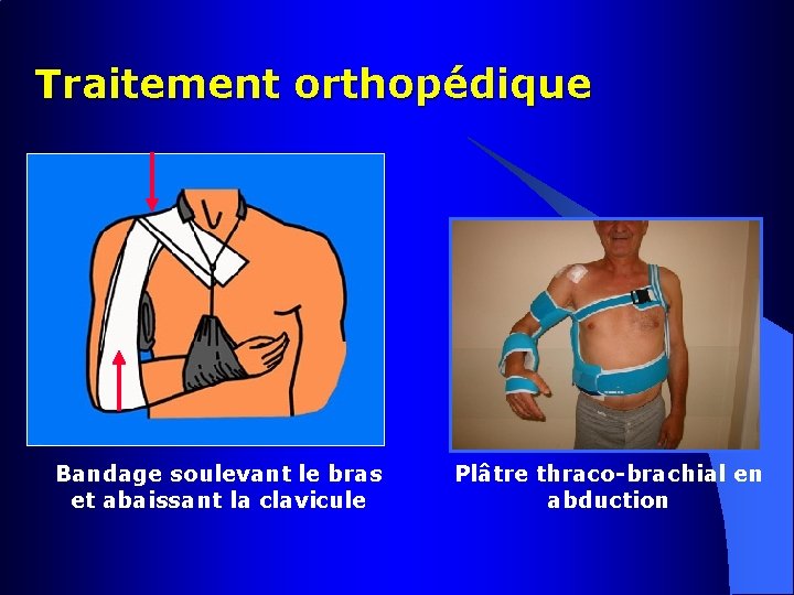 Traitement orthopédique Bandage soulevant le bras et abaissant la clavicule Plâtre thraco-brachial en abduction