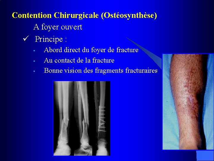 Contention Chirurgicale (Ostéosynthèse) A foyer ouvert ü Principe : • • • Abord direct