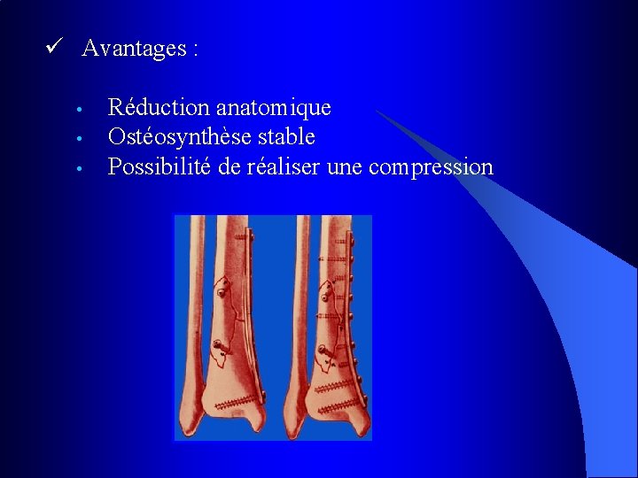 ü Avantages : • • • Réduction anatomique Ostéosynthèse stable Possibilité de réaliser une