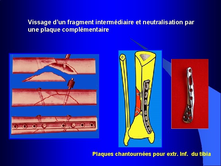 Vissage d’un fragment intermédiaire et neutralisation par une plaque complémentaire Plaques chantournées pour extr.