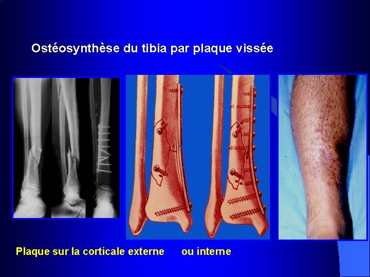 Ostéosynthèse du tibia par plaque vissée Plaque sur la corticale externe ou interne 