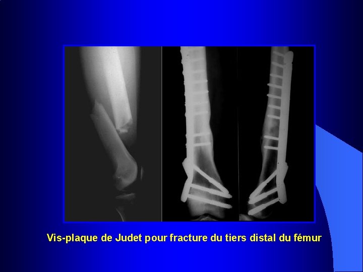 Vis-plaque de Judet pour fracture du tiers distal du fémur 