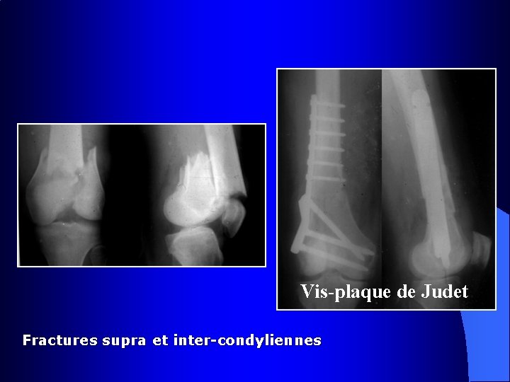  Vis-plaque de Judet Fractures supra et inter-condyliennes 