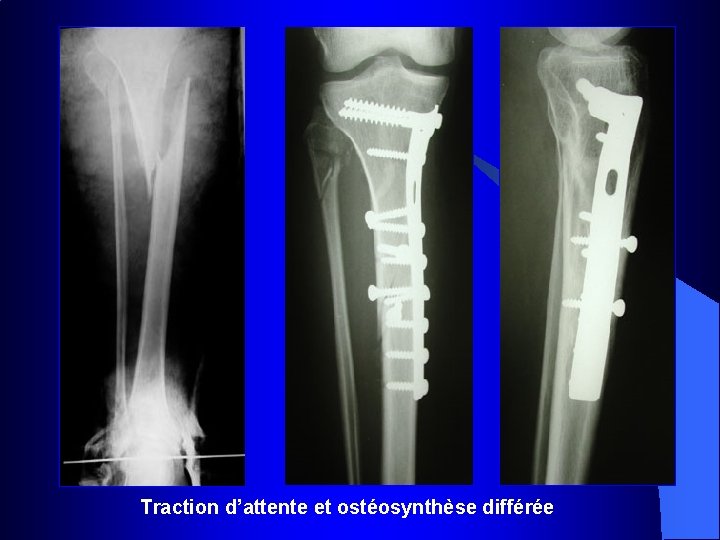 Traction d’attente et ostéosynthèse différée 