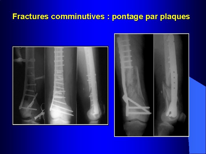 Fractures comminutives : pontage par plaques 