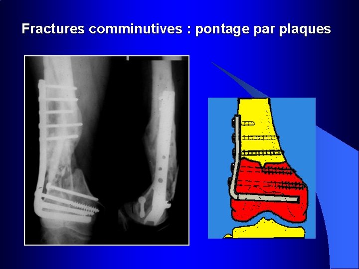 Fractures comminutives : pontage par plaques 