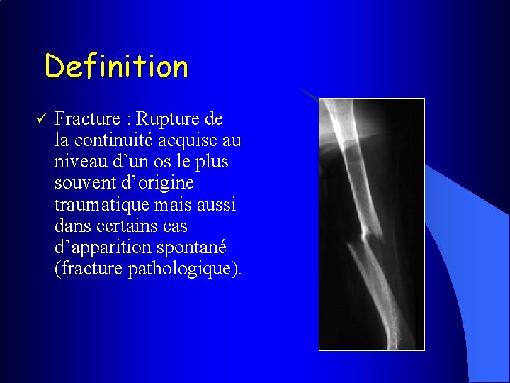 Definition ü Fracture : Rupture de la continuité acquise au niveau d’un os le