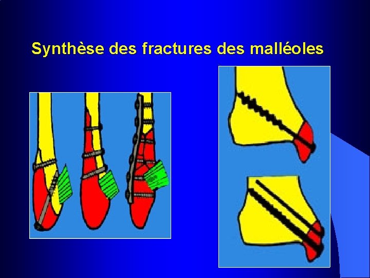 Synthèse des fractures des malléoles 