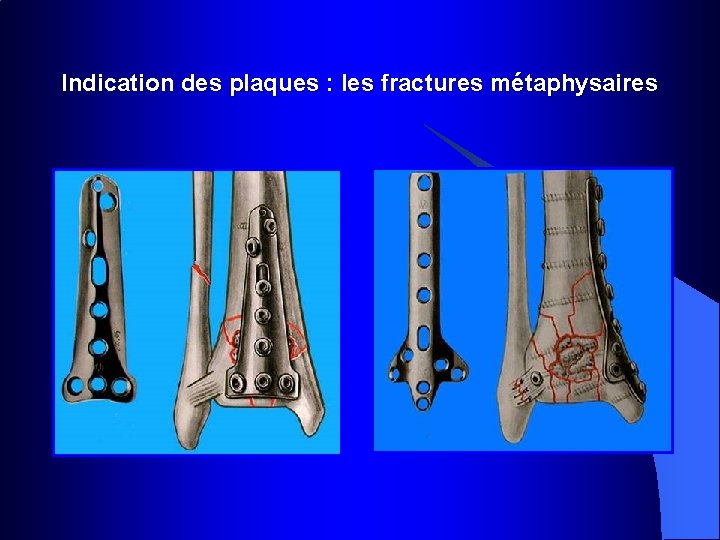 Indication des plaques : les fractures métaphysaires 