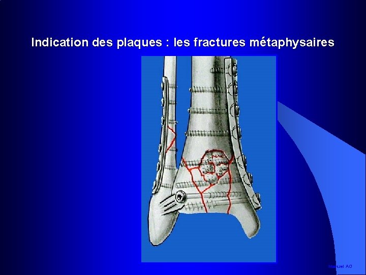 Indication des plaques : les fractures métaphysaires Manuel AO 