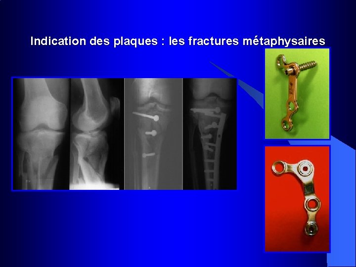 Indication des plaques : les fractures métaphysaires 