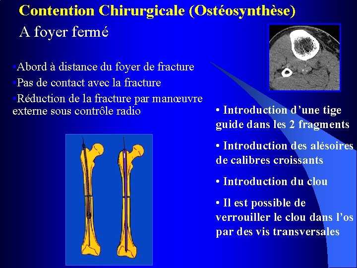 Contention Chirurgicale (Ostéosynthèse) A foyer fermé • Abord à distance du foyer de fracture