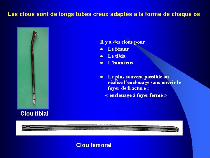 Les clous sont de longs tubes creux adaptés à la forme de chaque os