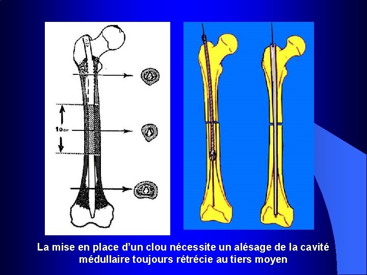 La mise en place d’un clou nécessite un alésage de la cavité médullaire toujours