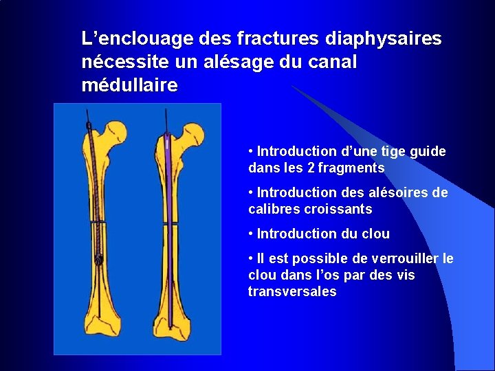 L’enclouage des fractures diaphysaires nécessite un alésage du canal médullaire • Introduction d’une tige