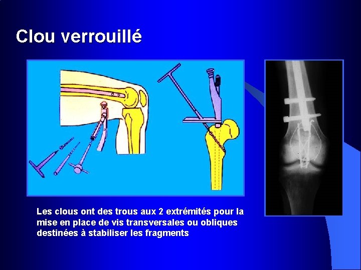 Clou verrouillé Les clous ont des trous aux 2 extrémités pour la mise en