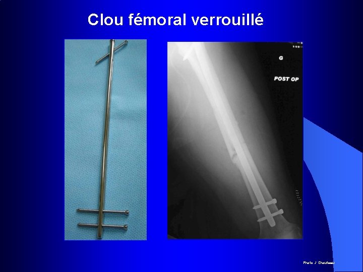 Clou fémoral verrouillé Photo J. Chouteau 