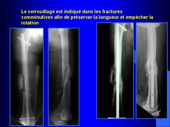 Le verrouillage est indiqué dans les fractures comminutives afin de préserver la longueur et