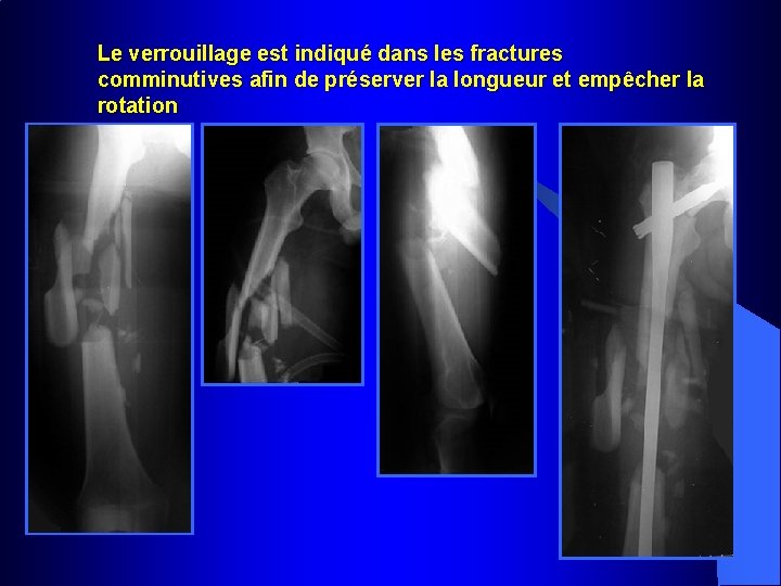 Le verrouillage est indiqué dans les fractures comminutives afin de préserver la longueur et