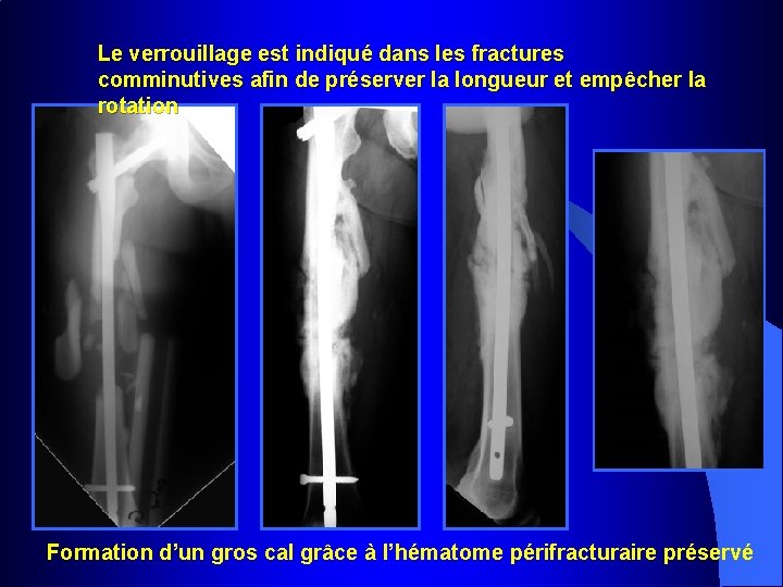 Le verrouillage est indiqué dans les fractures comminutives afin de préserver la longueur et