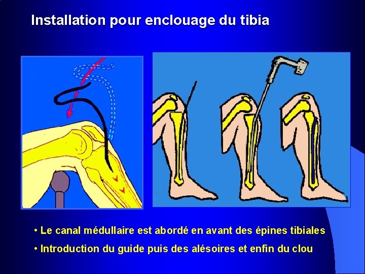 Installation pour enclouage du tibia • Le canal médullaire est abordé en avant des