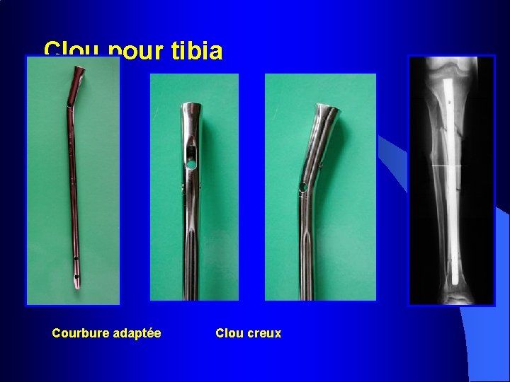 Clou pour tibia Courbure adaptée Clou creux 