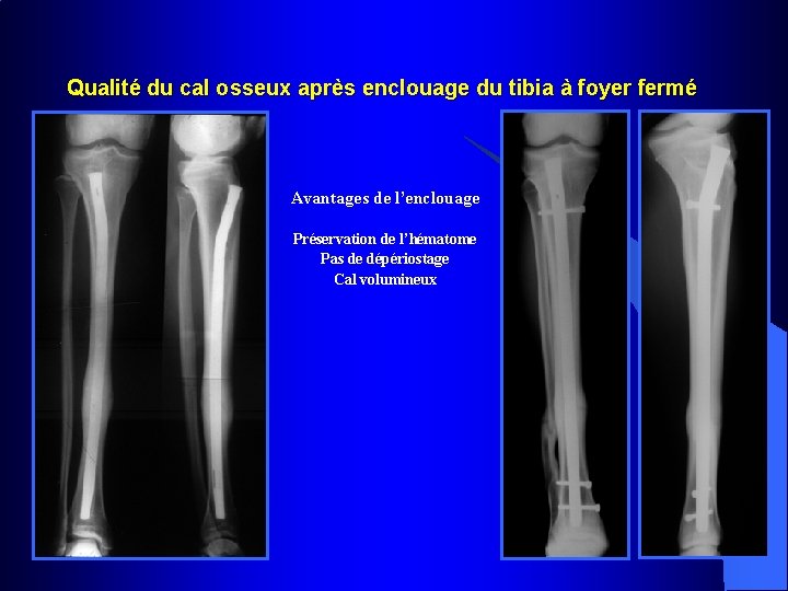 Qualité du cal osseux après enclouage du tibia à foyer fermé Avantages de l’enclouage