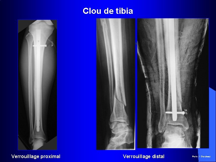 Clou de tibia Verrouillage proximal Verrouillage distal Photo J. Chouteau 