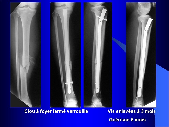  Clou à foyer fermé verrouillé Vis enlevées à 3 mois Guérison 6 mois