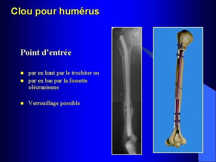 Clou pour humérus Point d’entrée l par en haut par le trochiter ou par