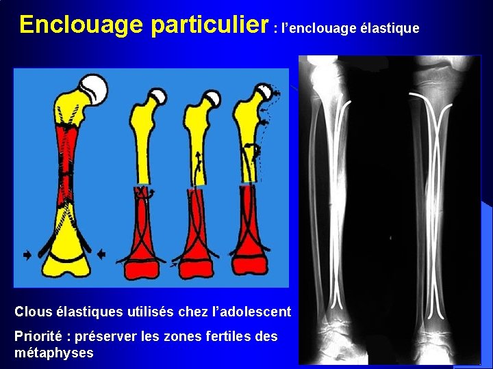 Enclouage particulier : l’enclouage élastique Clous élastiques utilisés chez l’adolescent Priorité : préserver les