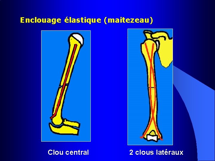 Enclouage élastique (maitezeau) Clou central 2 clous latéraux 