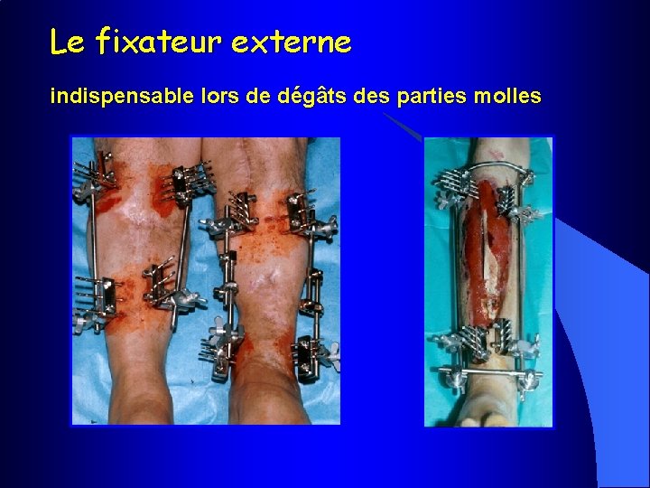 Le fixateur externe indispensable lors de dégâts des parties molles 