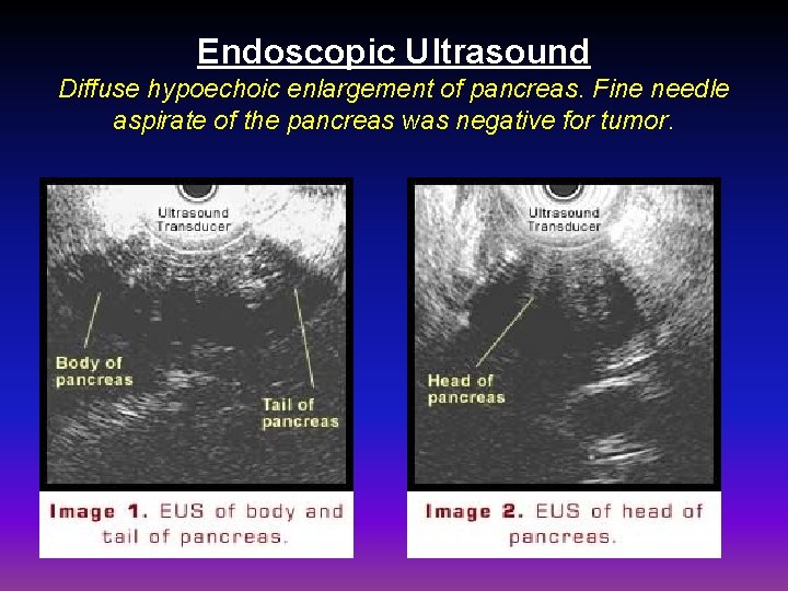 Endoscopic Ultrasound Diffuse hypoechoic enlargement of pancreas. Fine needle aspirate of the pancreas was