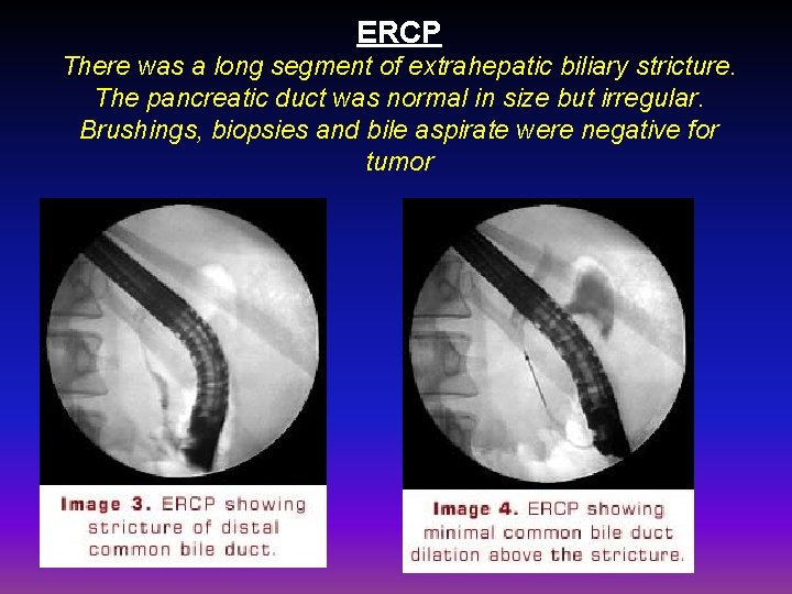 ERCP There was a long segment of extrahepatic biliary stricture. The pancreatic duct was
