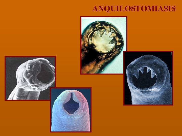 ANQUILOSTOMIASIS 