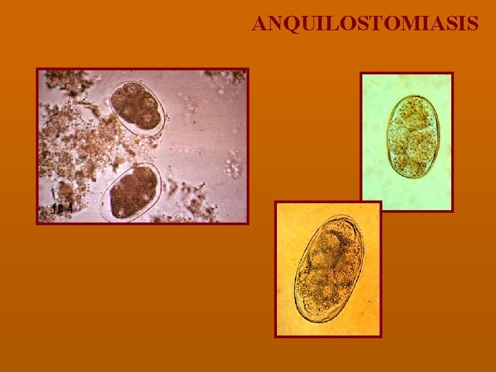 ANQUILOSTOMIASIS 