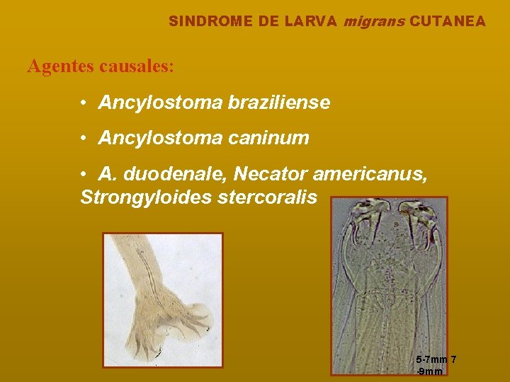 SINDROME DE LARVA migrans CUTANEA Agentes causales: • Ancylostoma braziliense • Ancylostoma caninum •