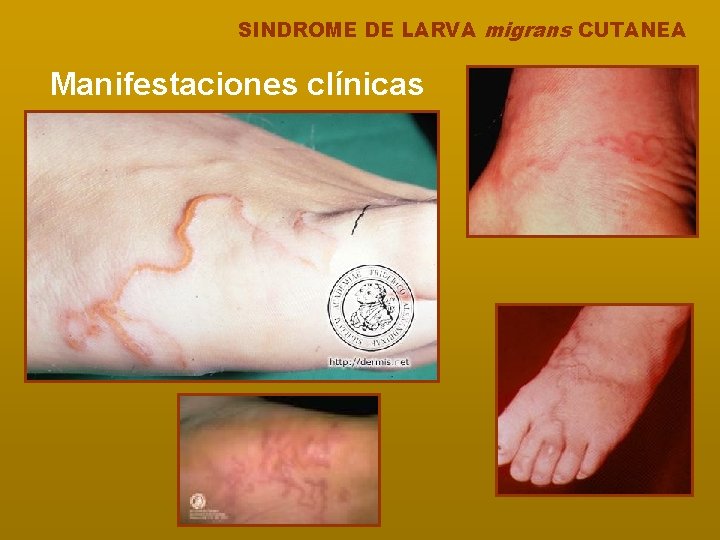 SINDROME DE LARVA migrans CUTANEA Manifestaciones clínicas 