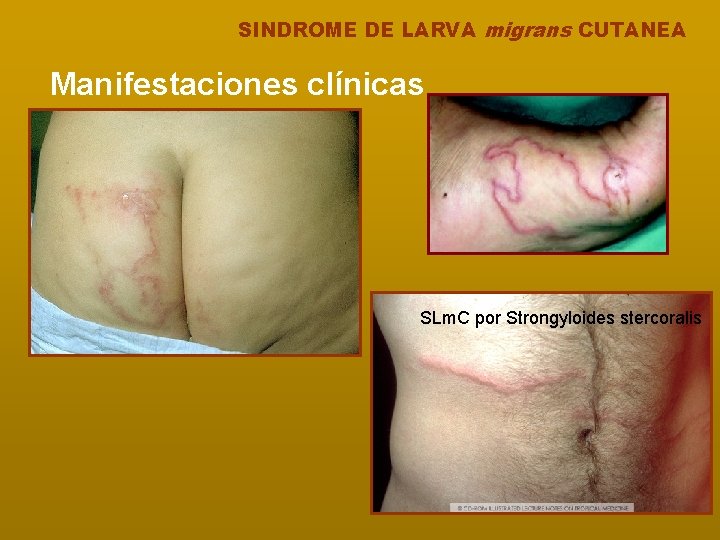 SINDROME DE LARVA migrans CUTANEA Manifestaciones clínicas SLm. C por Strongyloides stercoralis 