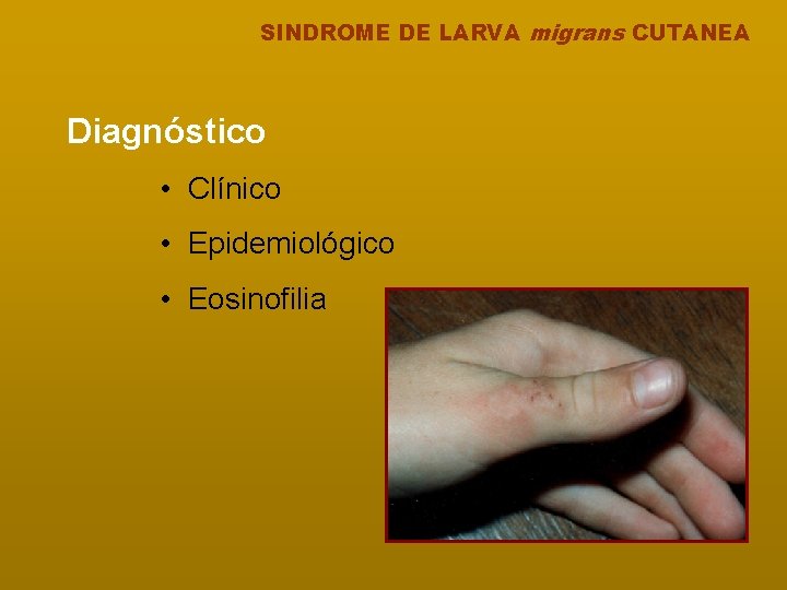 SINDROME DE LARVA migrans CUTANEA Diagnóstico • Clínico • Epidemiológico • Eosinofilia 