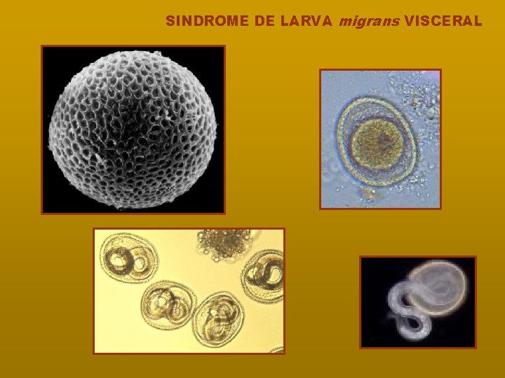 SINDROME DE LARVA migrans VISCERAL 