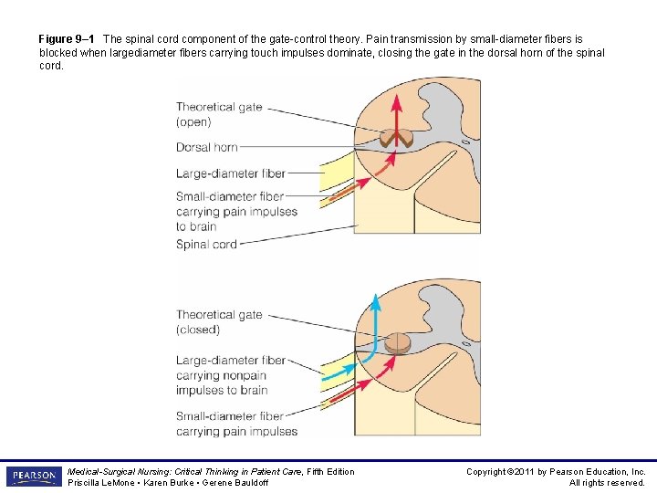 Figure 9– 1 The spinal cord component of the gate-control theory. Pain transmission by