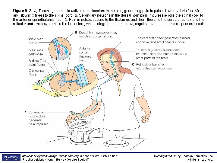 Figure 9– 2 A, Touching the hot lid activates nociceptors in the skin, generating