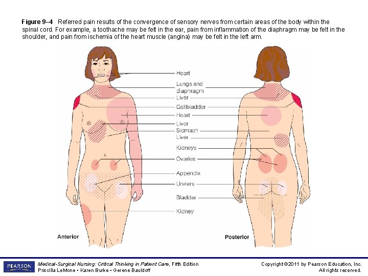 Figure 9– 4 Referred pain results of the convergence of sensory nerves from certain